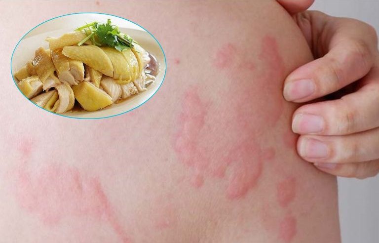 Ăn thịt gà bị nổi mề đay do đâu, triệu chứng ra sao, xử lý và phòng tránh thế nào