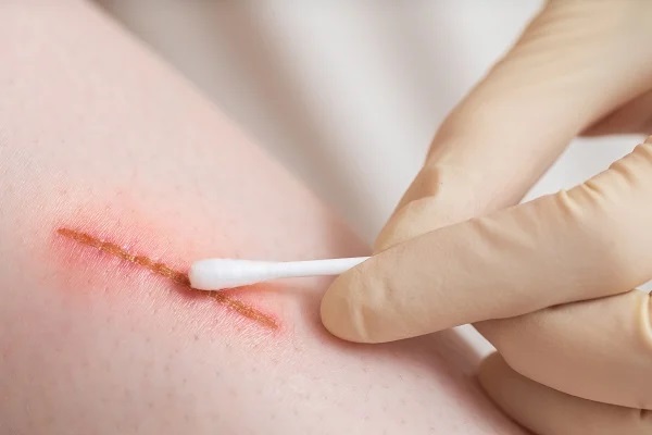 Vết thương hở ăn thịt gà được không, vai trò dinh dưỡng, lợi ích phục hồi, quan niệm kiêng kỵ
